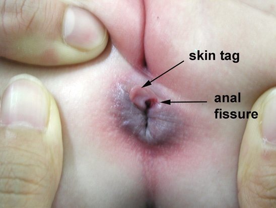 Bikini brazilian picture style wax